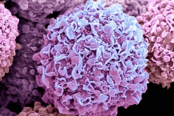 صورة مكبرة لخلية سرطانية